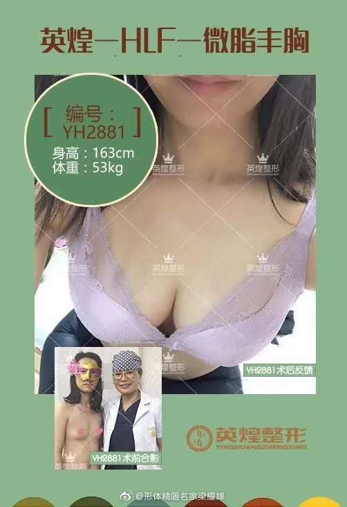 梁耀婵自体脂肪丰胸案例