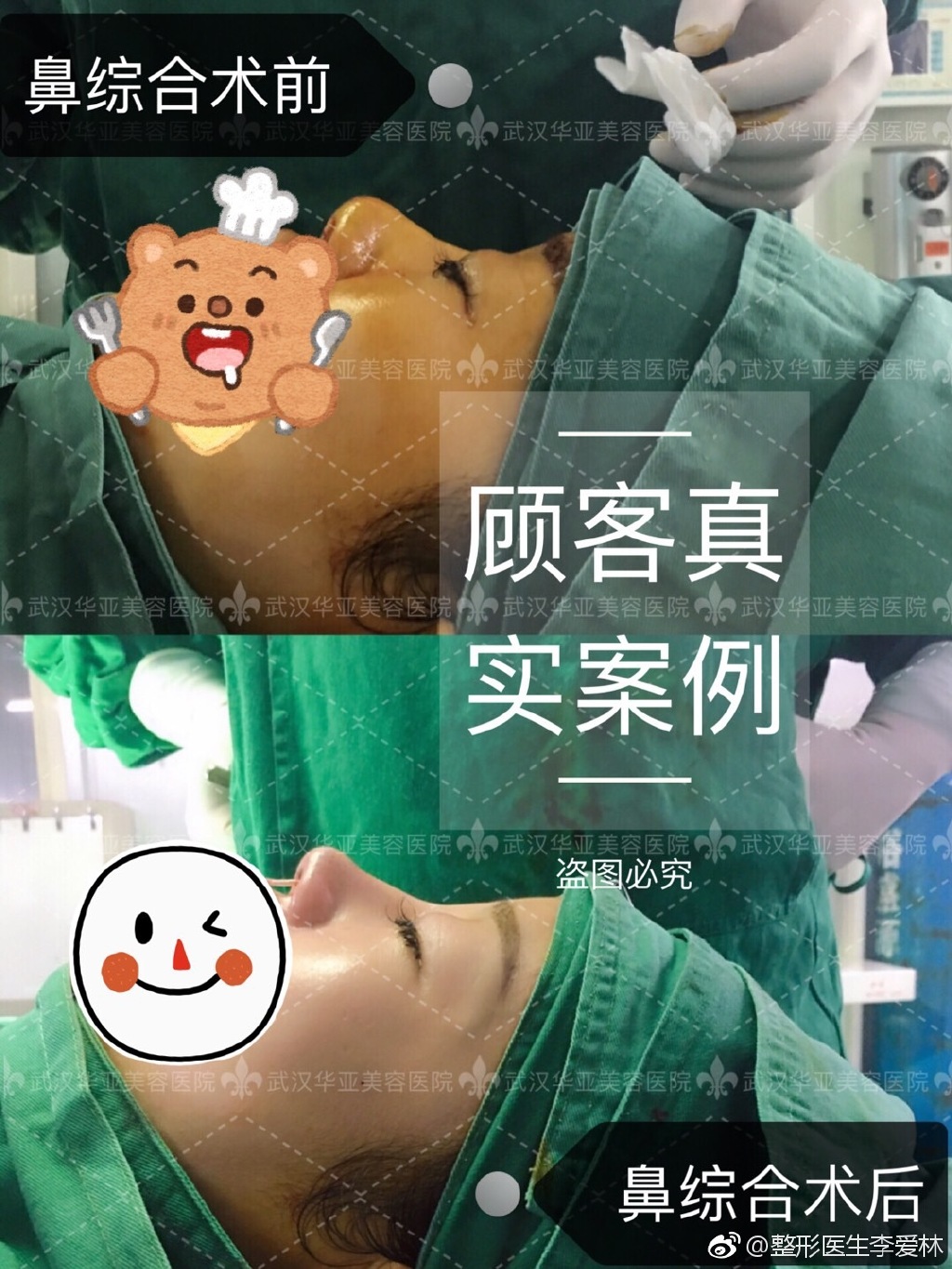 李爱林鼻综合案例